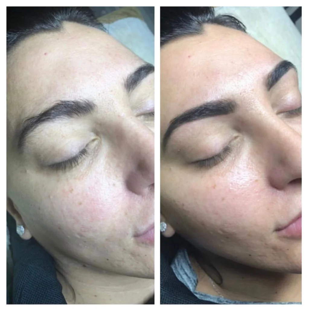 dermaplaning-before-after (2)