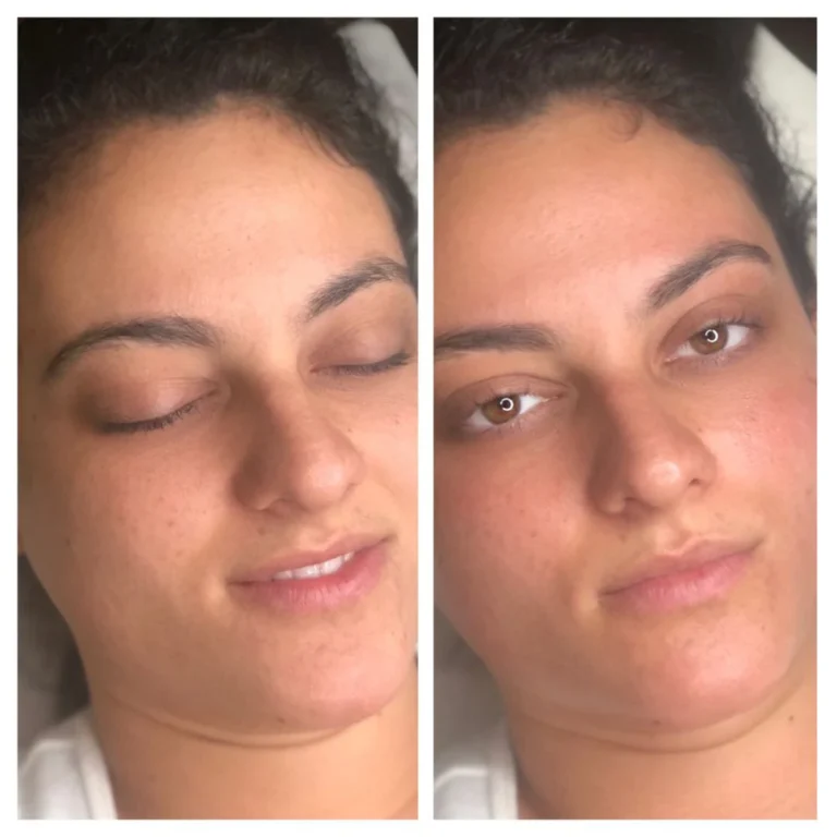 dermaplaning-before-after (3)